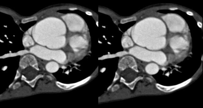 Dilated Aortic Root